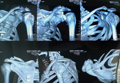 CT scan, 5 fractures!